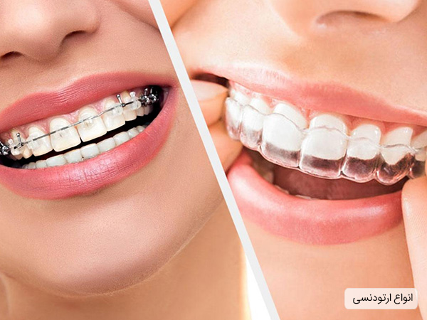 انواع مختلف ارتودنسی دندان