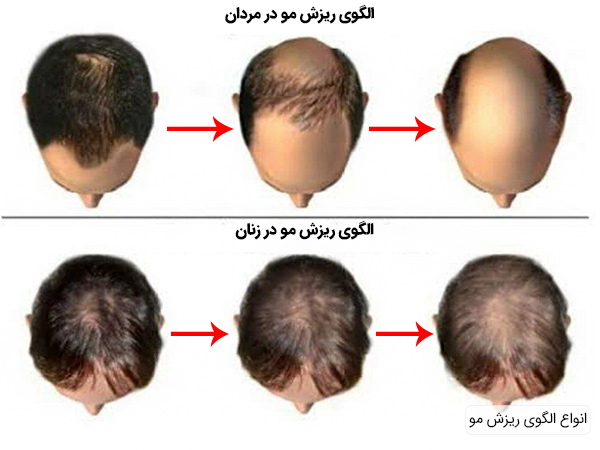 انواع الگوی ریزش مو در زنان و مردان