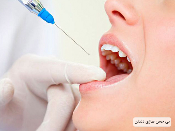 بی حس کردن دندان برای عصب کشی