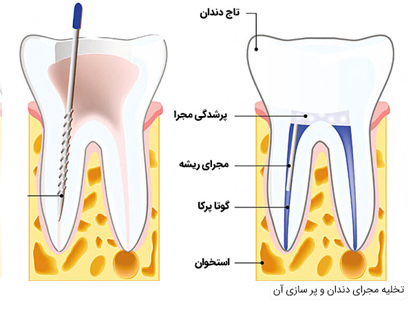 تخلیه عفونت دندان و پرسازی آن