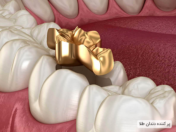 پر کننده دندان از جنس طلا
