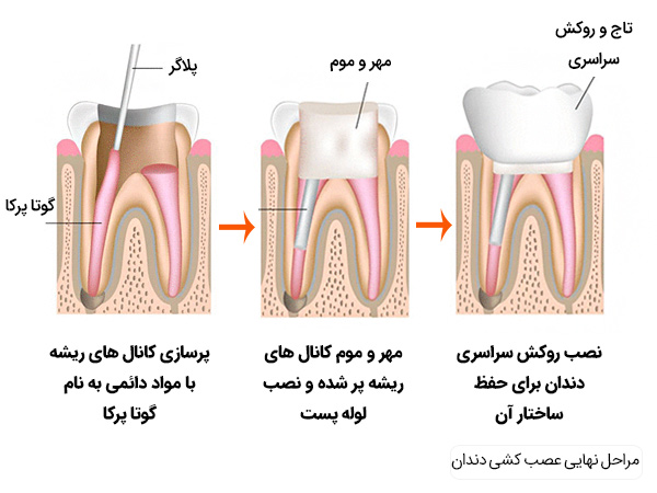 مراحل ننهایی عصب کشی دندان