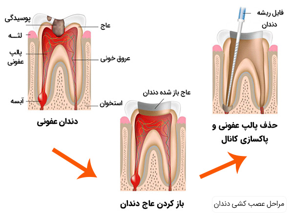مراحل اولیه عصب کشی دندان