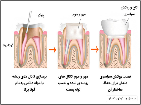 مراحل پاکسازی دندان و پر کردن آن