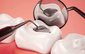 انواع مواد مورد استفاده برای پر کردن دندان