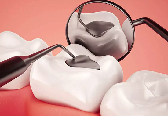 انواع مواد مورد استفاده برای پر کردن دندان