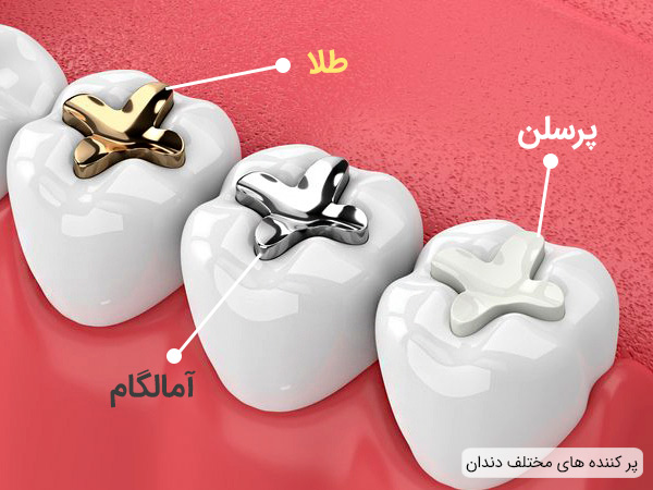تفاوت میان پر کننده های مختلف دندان