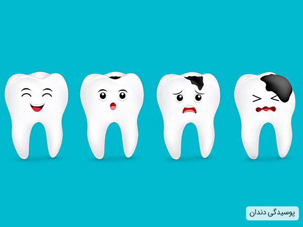 پوسیدگی دندان عامل اصلی عفونت پالپ