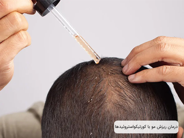 درمان ریزش مو با کورتیکواستروئیدها؛ استفاده از کرم‌ها و لوسیون‌ها