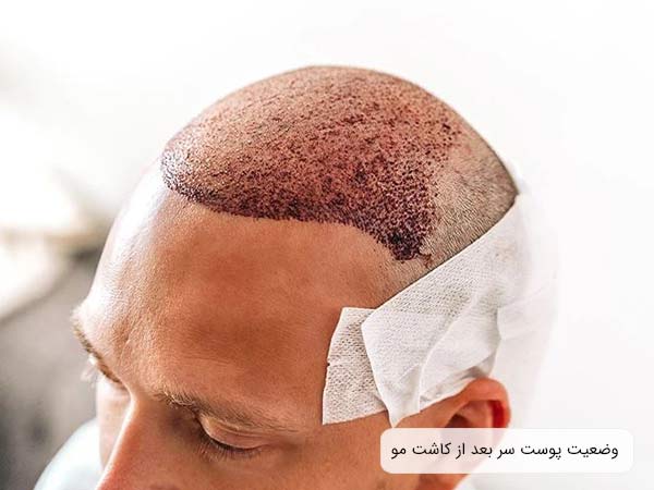 پوست سر يک مرد بعد از انجام کاشت مو که دچار خونريزی شده است.
