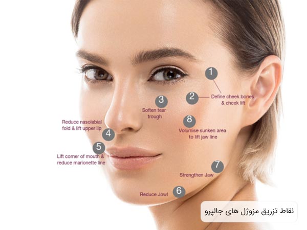 نقاط تزريق و کاربرد مزوژل هاي جالپرو روی پوست صورت يک خانم نشان داده شده است با پس زمينه سفيد.