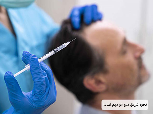 سرنگ تزريق کوکتل مزوتراپی مو که در دست پزشک قرار گرفته است.