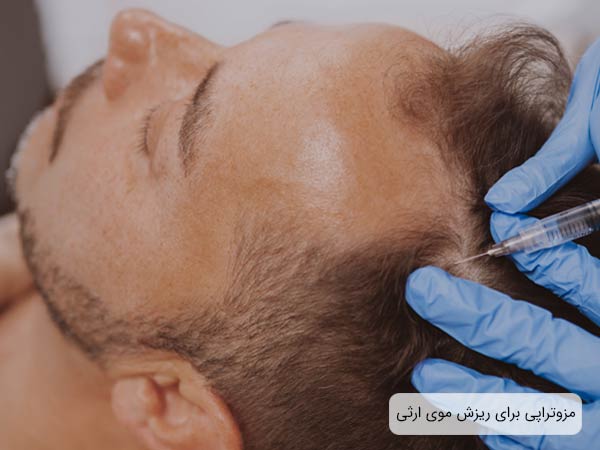 انجام مزوتراپی توسط پزشک روی سر يک آقاي جوان که دچار ريزش موی ارثی شده است.