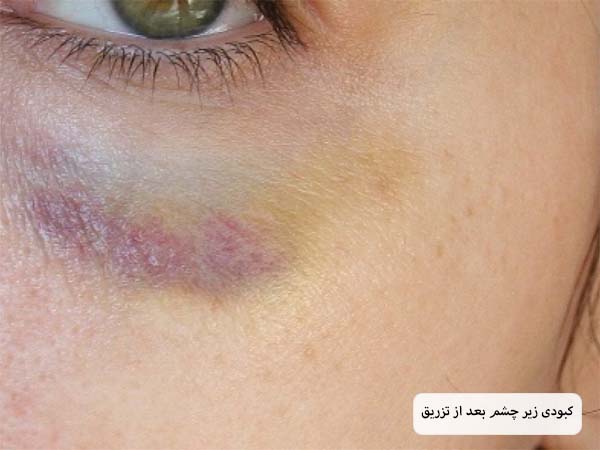 قسمت زیر چشم یک خانم که بعد از تزریق فیلر دچار کبودی شده است.
