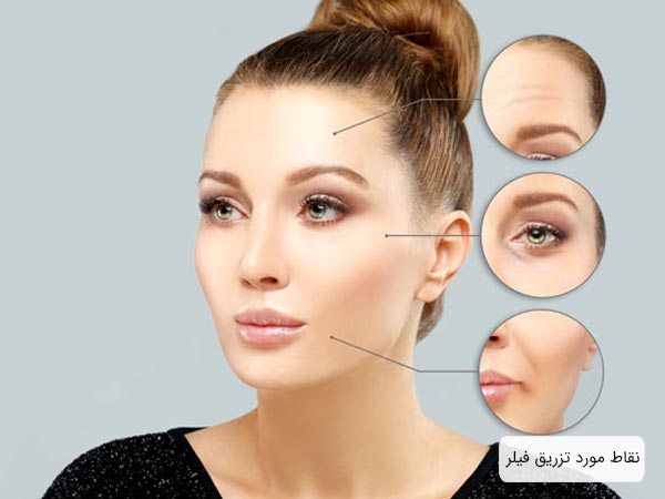 نققاط معمول براي تزريق روي صورت يک خانم نمايش داده شده اند با پس زمينه خاکستري رنگ.