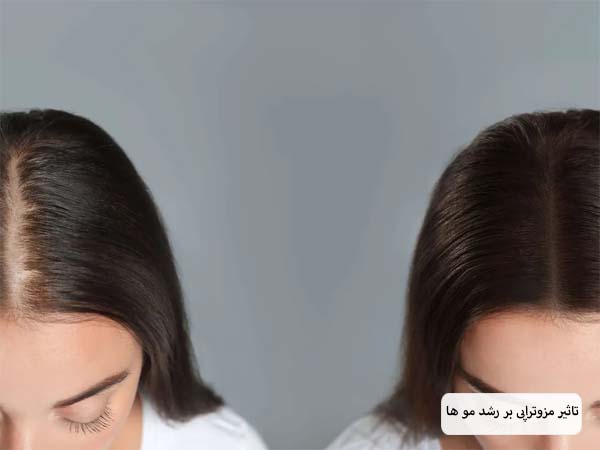 تصویری از موی سر یک خانم قبل و بعد از انجام مزوتراپی که مو های سر او افزایش چشم گیری داشته است با پس زمینه طوسی رنگ.