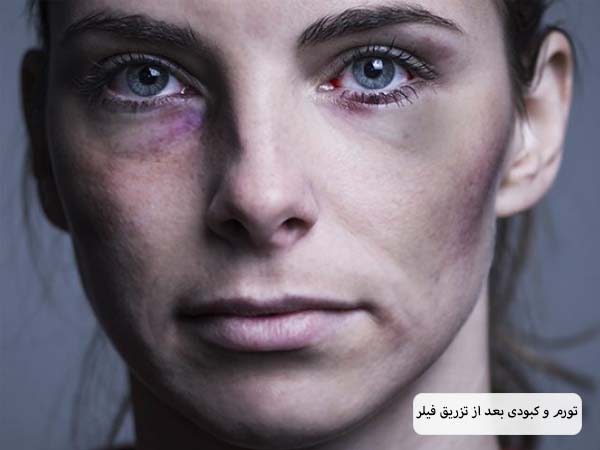 صورت یک خانم جوان که بعد از تزریق فیلر دچار کبودی در نواحی متعدد شده است.