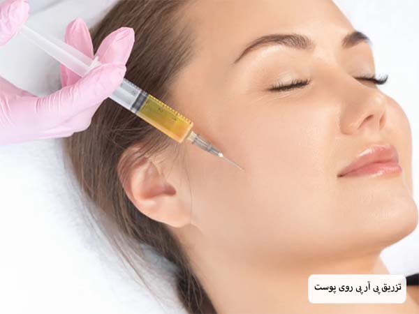 سرنگ حاوی پی آر پی که روی صورت یک خانم جوان قرار داده شده و آماده تزریق است.