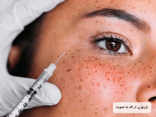 تزریق پی ار اف به صورت یک خانم توسط متخصص.