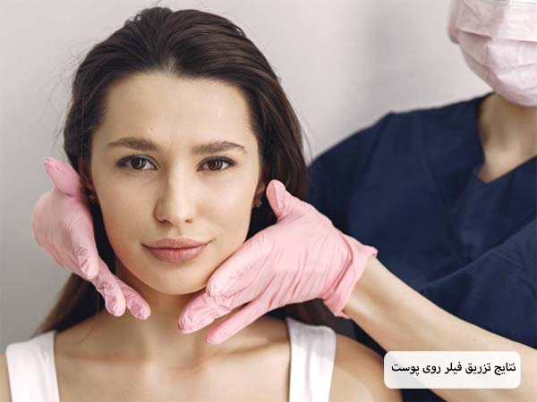 قسمت زیر چشم یک خانم که بعد از تزریق فیلر دچار کبودی شده است.