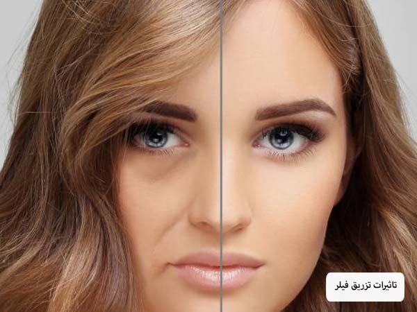 صورت یک خانم که با تزریق فیلر و ژل حجیم تر شده است.