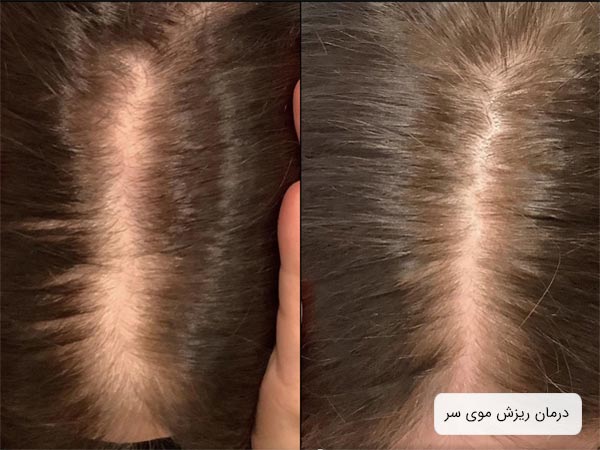 موهاي سر يک خانم که بعد از درمان ريزش مو، رشد بيشتر و موهاي پرپشت تري داشته است.
