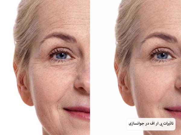 صورت یک خانم مسن قبل و بعد از تزریق پی ار اف در پس زمینه سفید.