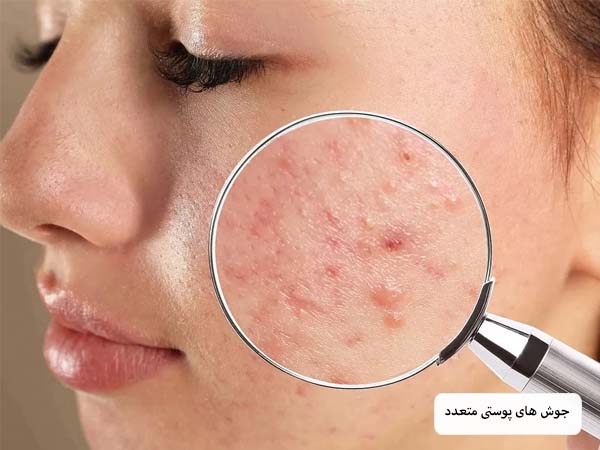صورت یک خانم که دچار جوش های متعدد و آکنه است.