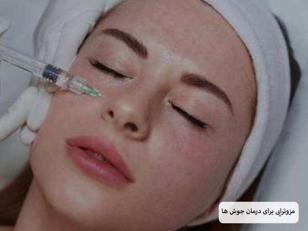 تزریق کوکتل مزوتراپی ضد جوش به صورت یک خانم جوان توسط پزشک.