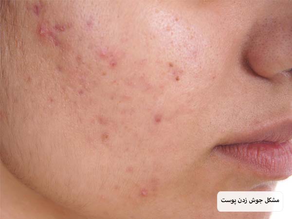 صورت یک خانم جوان که دچار جوش زدن است با پس زمینه سفید.